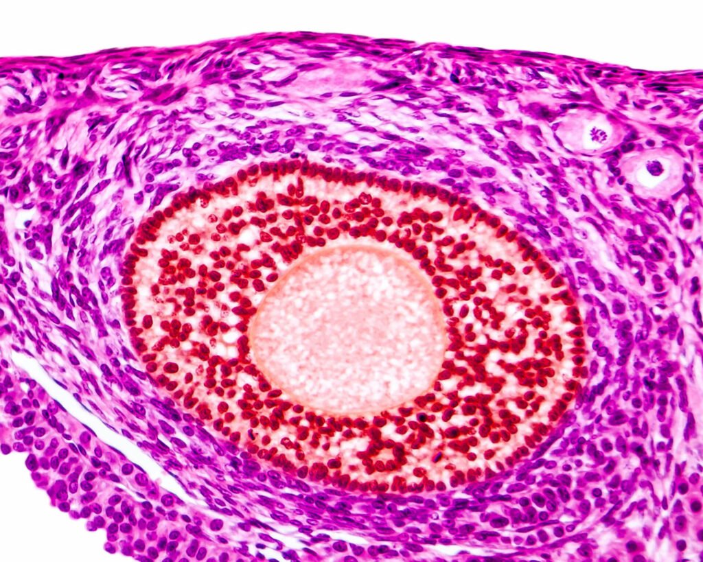 Les signes d'une ovulation de mauvaise qualité sont souvent le symptôme d'une pathologie gynécologique plus profonde